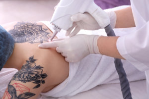 fatores que influenciam na remocao de tatuagem