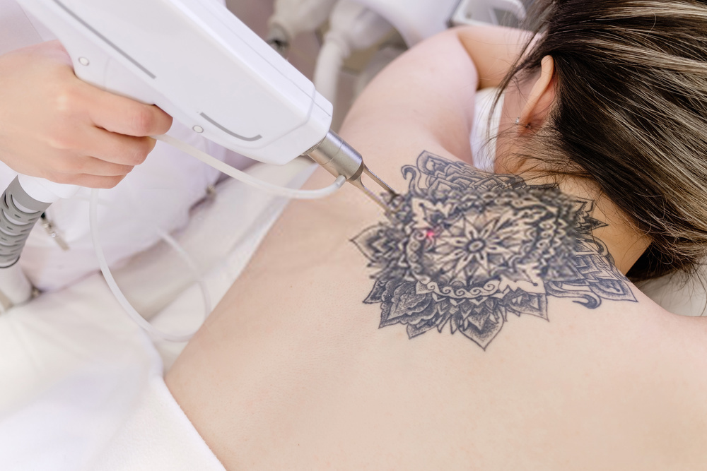remoção de tatuagem com laser rubi
