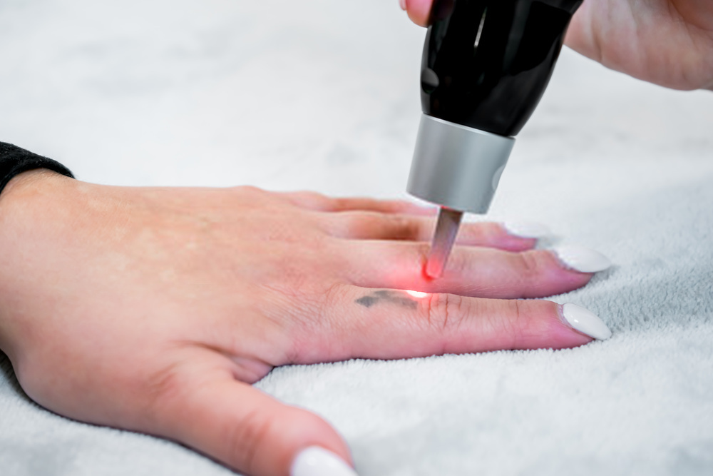 laser rubi para remoção de tatuagem