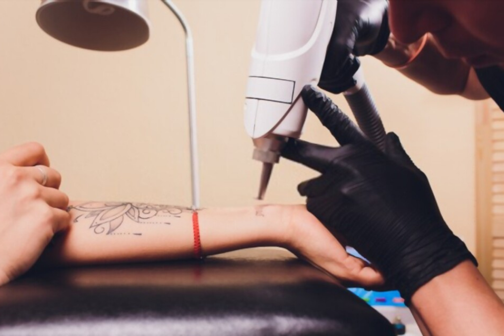 tatuadores adoram a remoção a laser